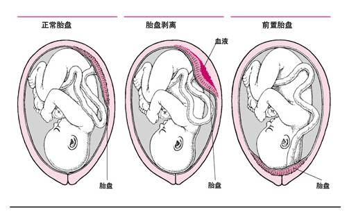 三个月胎盘前置，正常与否的探讨